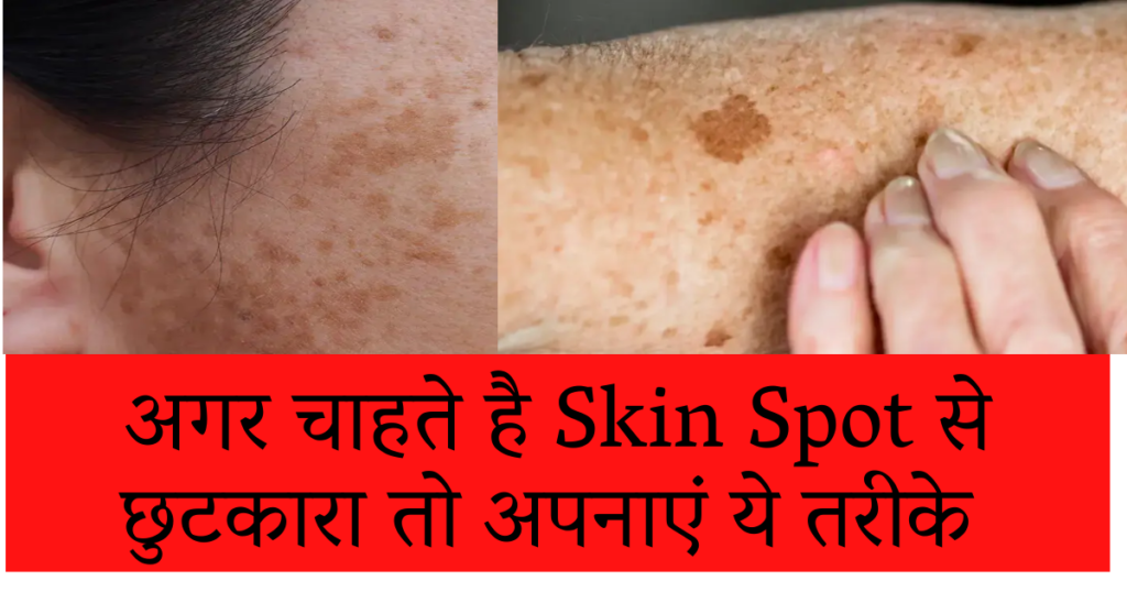 Skin Spots