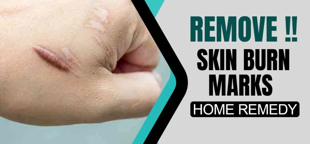 Home Remedies for removing burnt marks